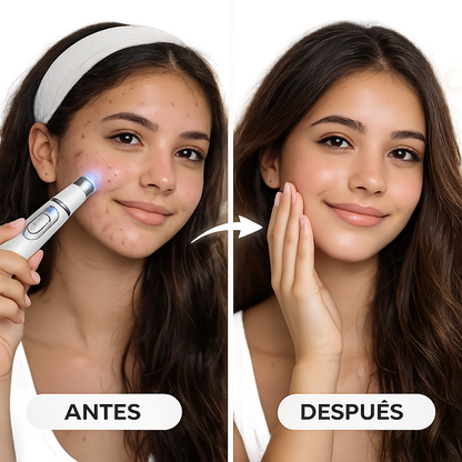 Bolígrafo Antiacné LED